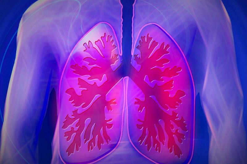 le cancer du poumon