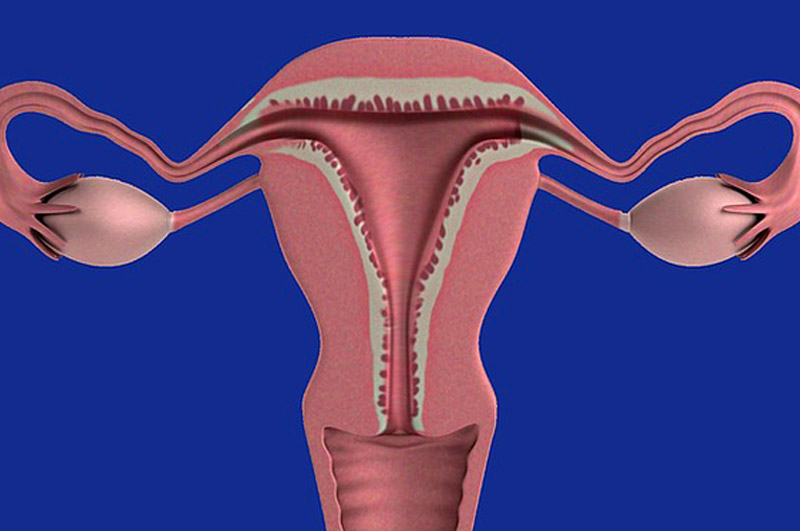 le cancer des ovaires