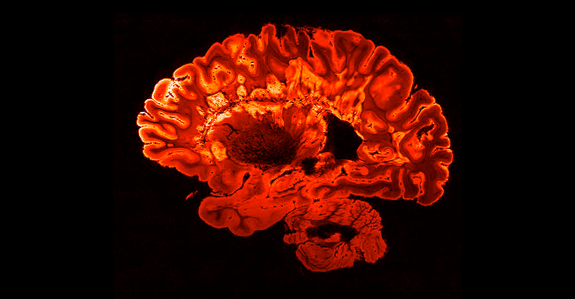 IRM rouge du cerveau